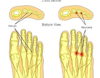 Morton's neuroma